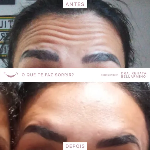 Resultado procedimento com a Dra. Renata Bellarmino.