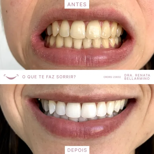 Resultado procedimento com a Dra. Renata Bellarmino.