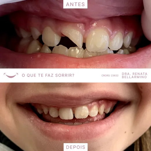 Resultado procedimento com a Dra. Renata Bellarmino.